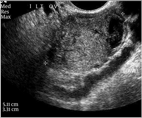 Ovarian Cyst 5cm