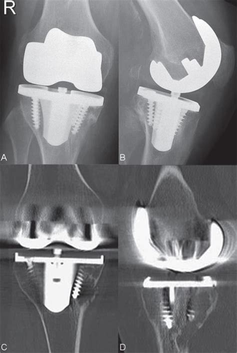 Tka Aseptic Loosening Recon Orthobullets