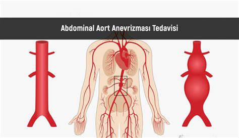 Abdominal Aort Anevrizmas Nedenleri Ve Tedavisi Tedavi Tc