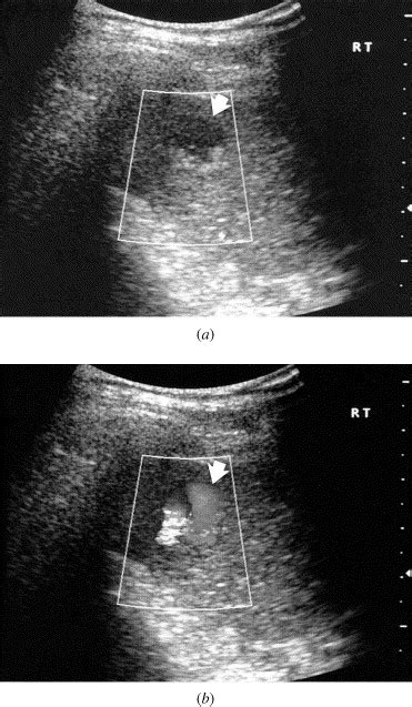 Calcified Portal Vein Aneurysm And Portohepatic Venous Shunt In A