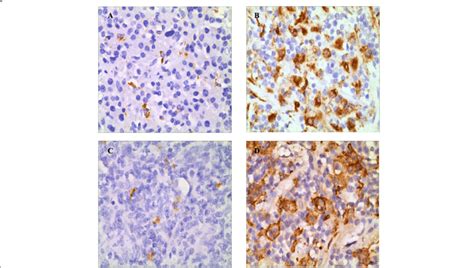 Cd68 And Cd163 Expression In Dlbcl Tissues ×400 A Low Cd68 Download Scientific Diagram