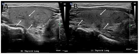 Thyroid Ultrasound Longitudinal View Revealed That The Thyroid Gland Download Scientific