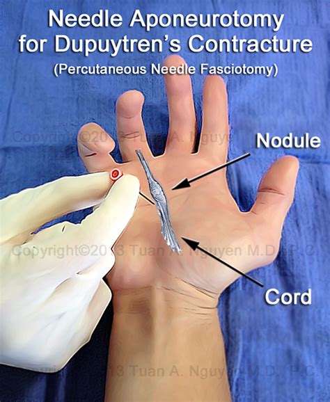 Needle Aponeurotomy For Dupuytren S Contracture Lake Oswego Hand