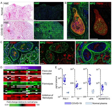 Vascular Injury And Mediators Of Coagulopathies In Covid Lung