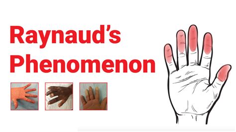 Raynaud's Phenomenon : What You Should Know • Johns Hopkins Rheumatology