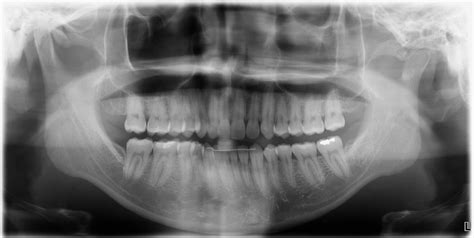 Right Condylar Hypertrophy Or Left Condyle Flattening Rjawsurgery