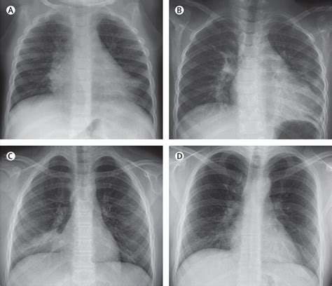 Viral Pneumonia The Lancet