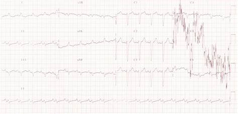 Electrocardiogram Of The Patient Showing Sinus Tachycardia Heart Rate