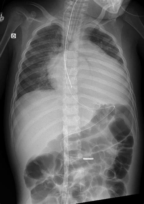 Sonda Nasog Strica Radiografia Abdomen Pediatras Hot Sex Picture