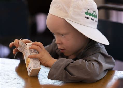Albinism - Stichting Josephat Torner Foundation Europe