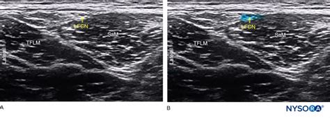 Regional Anesthesia Ultrasound Anatomy Lateral Femoral Cutaneous Nerve