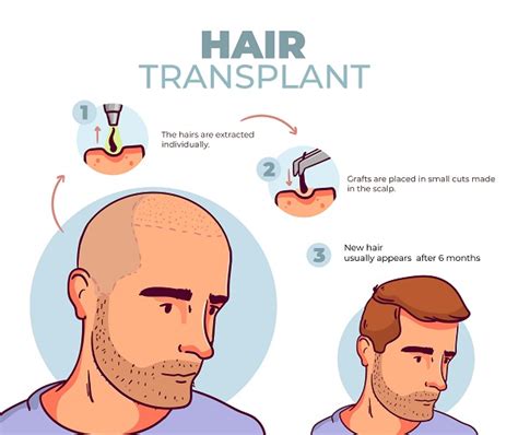 Fue Hair Transplant What Is It Procedure And Cost Hair Transplant