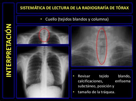 Diagnóstico Por Imágenes Radiografía De Tórax Normal