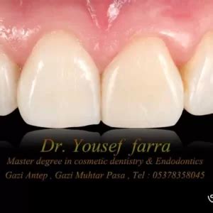 The Best Crowns And Bridges Service Arslan Dental Clinic