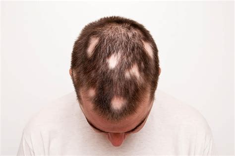 Alopecia Areata Treatment In Singapore Price Reviews FAQs