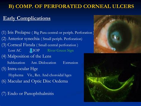 Ppt The Cornea Powerpoint Presentation Free Download Id4800497