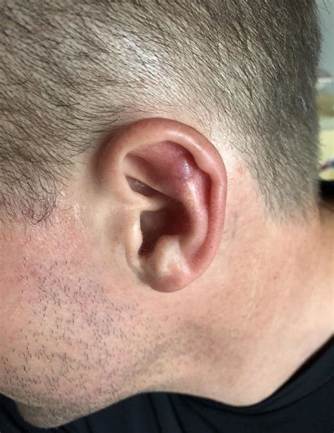 Please Help Melanoma