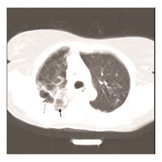 75-year-old male. Spiral CT scan at the level of pulmonary artery (lung... | Download Scientific ...