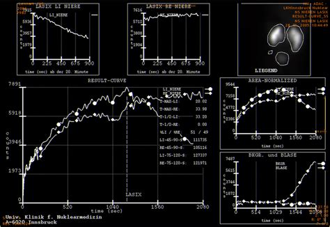 MAG3 scan in unilateral hydronephrosis showing obstruction. | Download ...