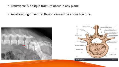 Spinal Instabilitypptx