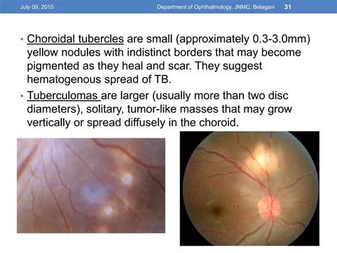 Infectious Uveitis Ppt