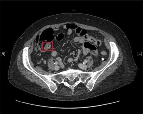 CT abdomen demonstrating an air and fluid-filled appendix, highlighted ...