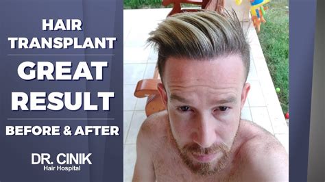 Great Result Hair Transplant Dr Emrah Cinik Youtube