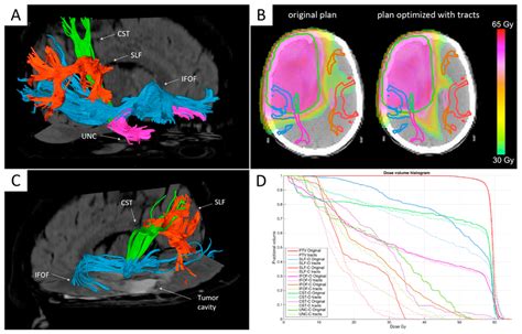 Integration Of Multiple White Matter Tracts As Depicted By MR