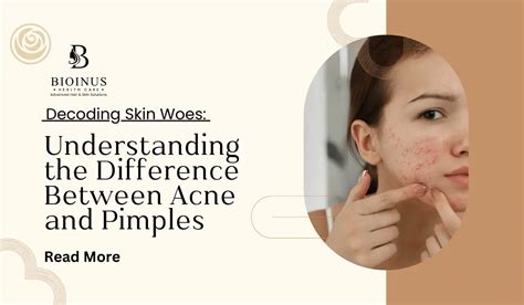 Understanding The Difference Between Acne And Pimples Bioinus Health Care