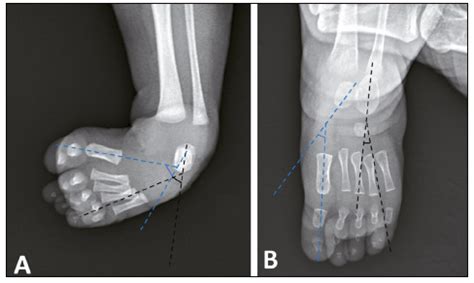 Scielo Brasil Evaluation Of Early Treatment Of Idiopathic Clubfoot