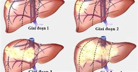Các giai đoạn của ung thư gan | Báo Dân trí 