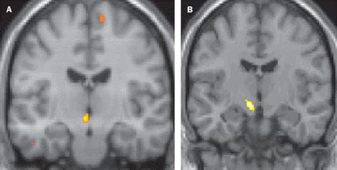 Pathophysiology Of Cluster Headache A Trigeminal Autonomic Cephalgia