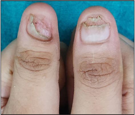 Clinical Characteristics And Management Outcomes In Isolated Nail