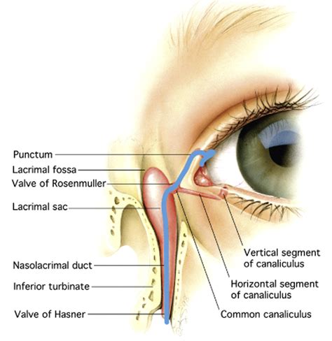 Use Of The Masterka For Complex Nasolacrimal Duct Obstruction In