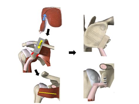 Open Stabilisation Latarjet Procedure