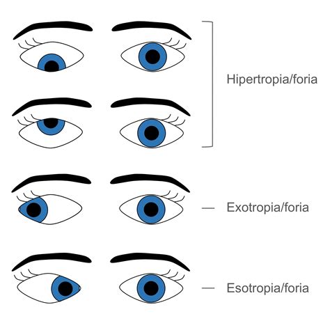 Estrabismo Metis