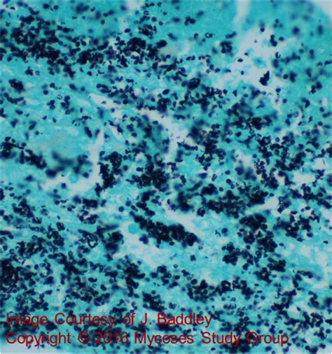 November 2017 Mycology Case of the Month - Doctor Fungus