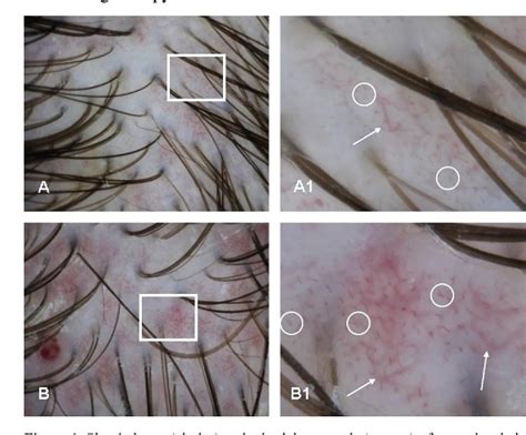 Figure 1 From Dermoscopic Findings In Psoriasis And Seborrheic Dermatitis On The Scalp And