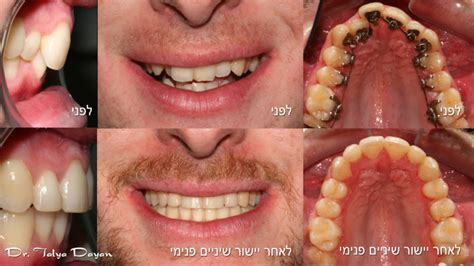 Lingual Braces Before And After