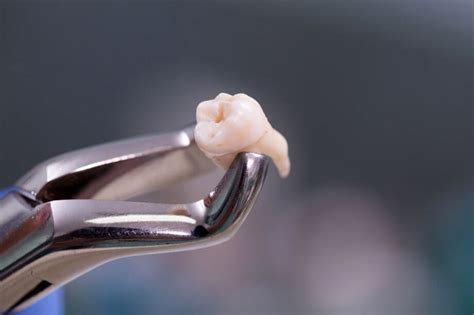 What To Expect After Wisdom Tooth Extraction Rosewood Dental