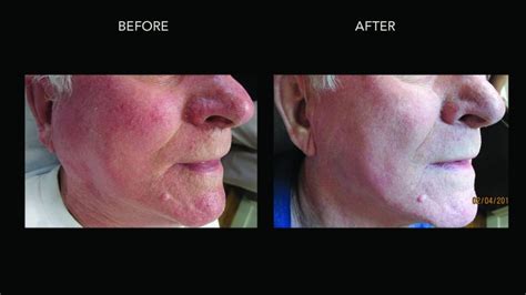 Rosacea Treatment Kelowna Facial Redness