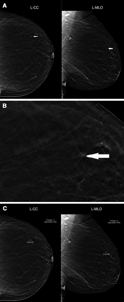 Screening Mammogram Of A 55 Year Old Woman A Craniocaudal Cc And