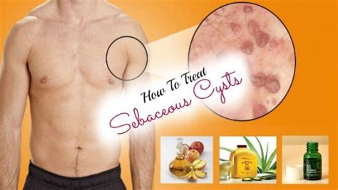 12 Ways On How To Treat Sebaceous Cysts Naturally At Home