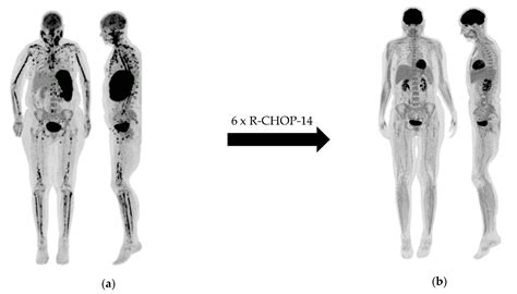 Cancers Free Full Text FDG PET Imaging For Hodgkin And Diffuse