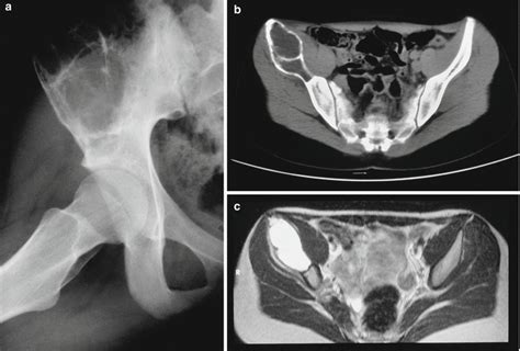 Simple Bone Cyst Musculoskeletal Key