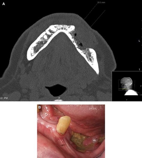 Chronic Osteomyelitis Of The Mandible Diagnosis And Management—an