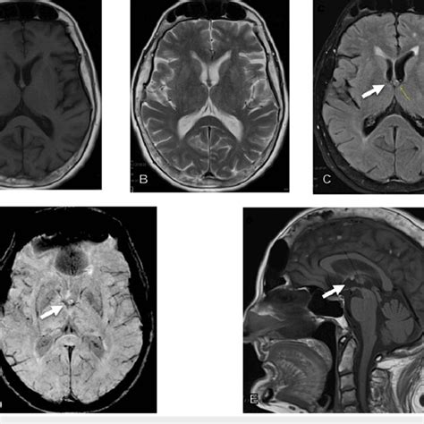 MRI brain study that depicted a colloid cyst (white arrows) that was ...