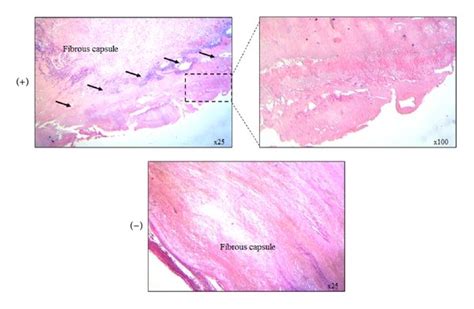 Histology section of a single patient: RF ablation induces coagulative... | Download Scientific ...