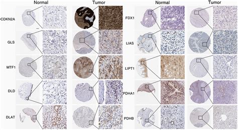 Clinical Significance And Integrative Analysis Of The Cuproptosis