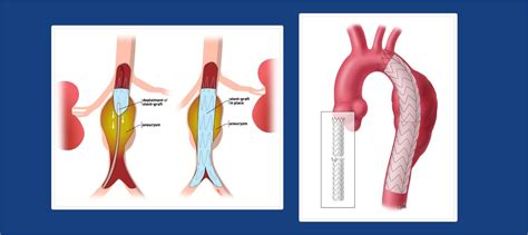 EVAR & TEVAR For Aortic Dissection/Aneurysm | Ahmedabad